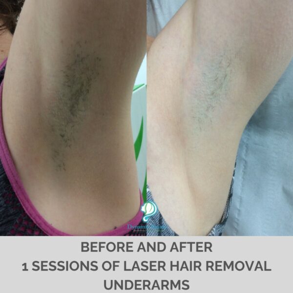 1 Sessions of Laser Hair Removal Back