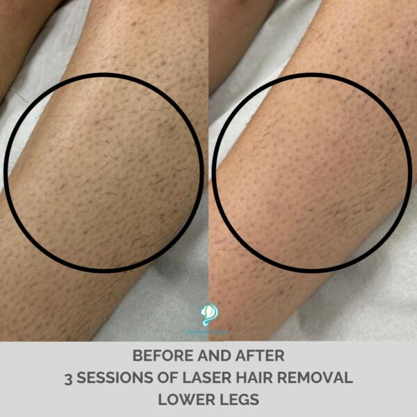 3 Sessions of Laser Hair Removal Lower Legs