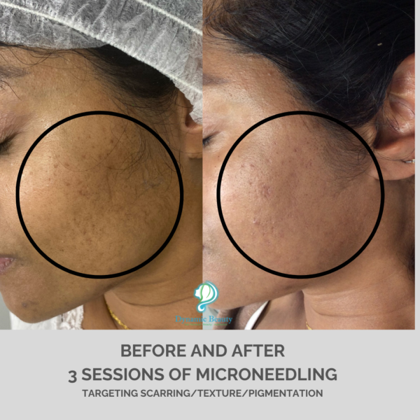 3 session microneedling