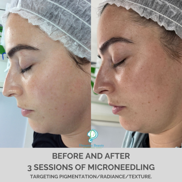 3 sessions microneedling