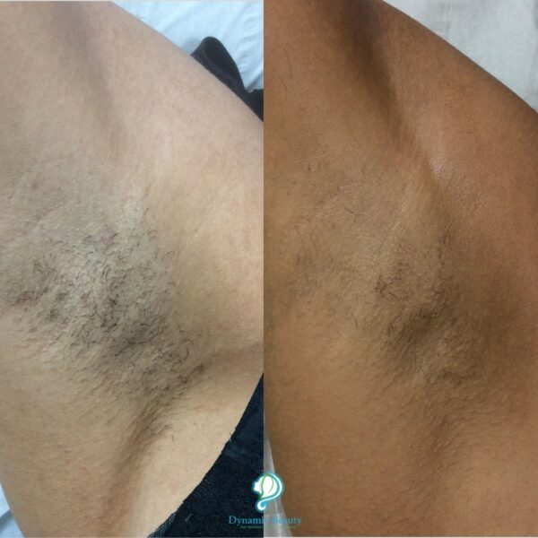 4 Sessions of Laser Hair Removal Underarm