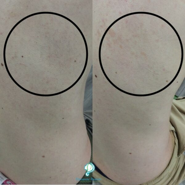 6 Sessions of IPL Hair Removal Back (1)