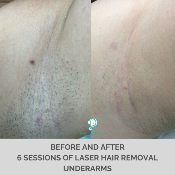 6 Sessions of Laser Hair Removal Underarm (1)