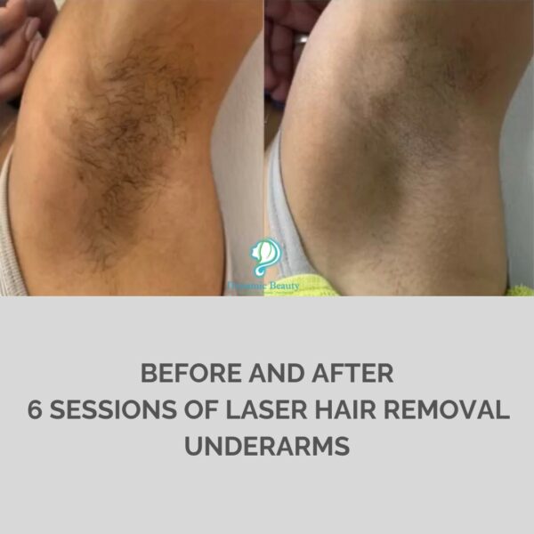6 Sessions of Laser Hair Removal Underarm