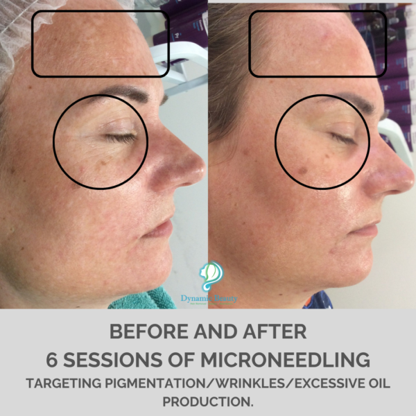 6 session microneedling