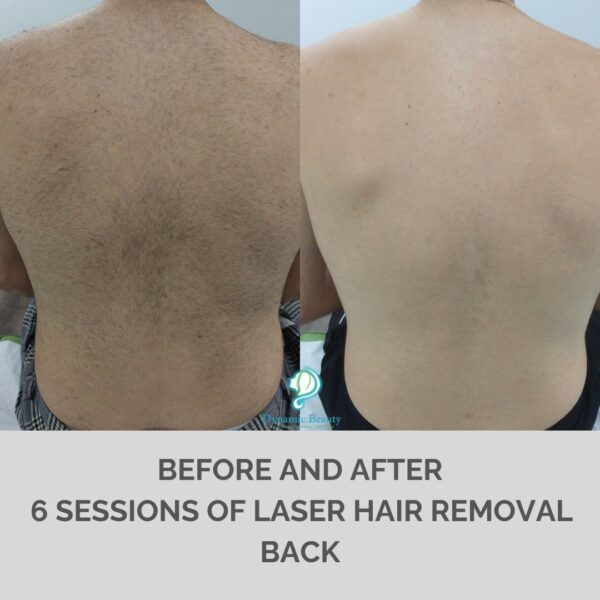 6 session of IPL hair removal Back