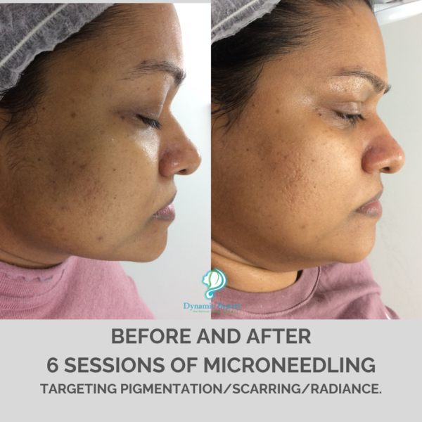 6 sessions microneedling (1)