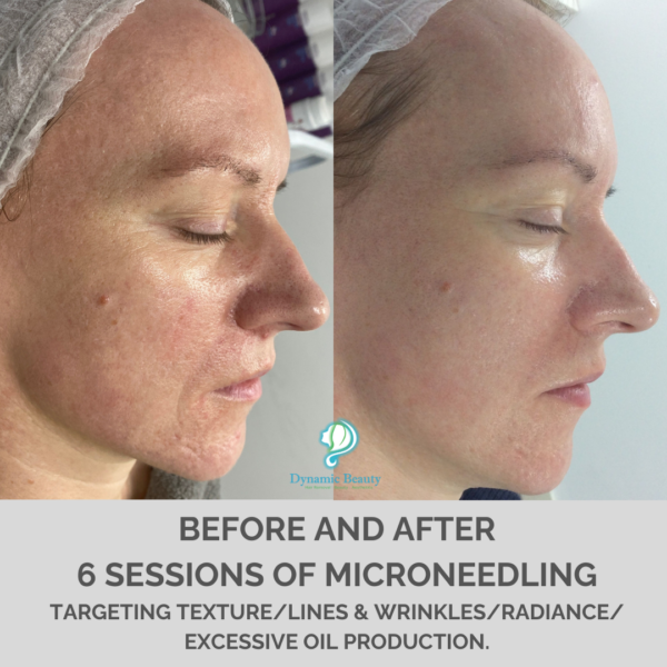 6 sessions microneedling
