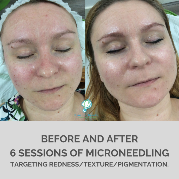 6 sessions of microneedling