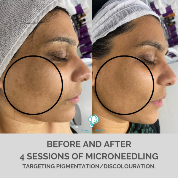 Copy of 6 sessions microneedling