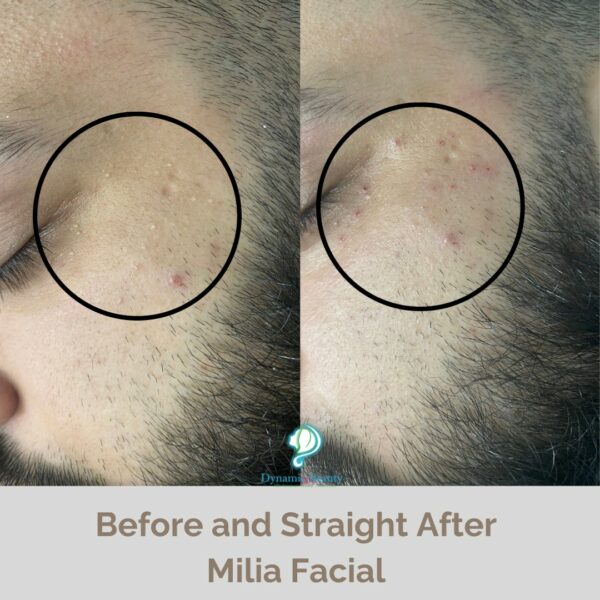 Copy of Milia Facial before and after