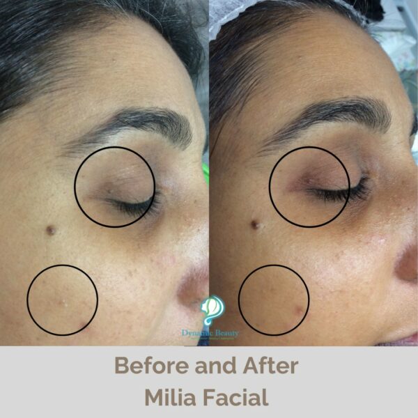 Milia Facial before and after (1) (1)