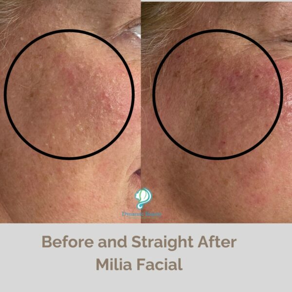 Milia Facial before and after (2)