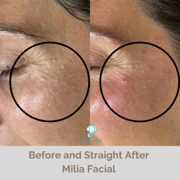 Milia Facial before and after (3) (1)