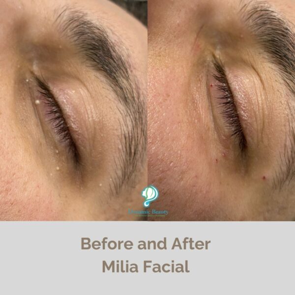 Milia Facial before and after