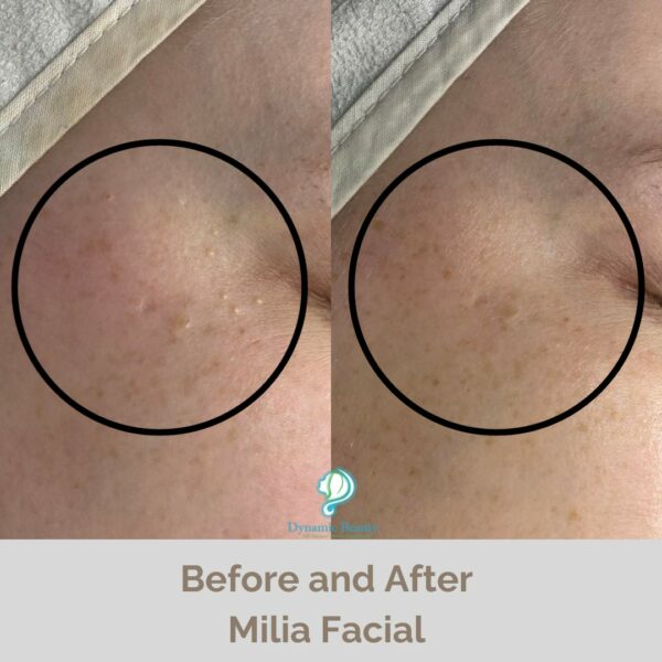 _Milia Facial before and after