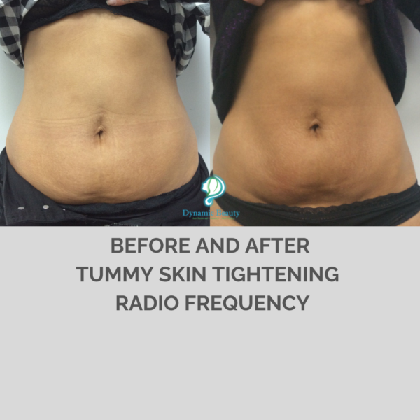 Radio Frequency Skin Tightening Body Treatment