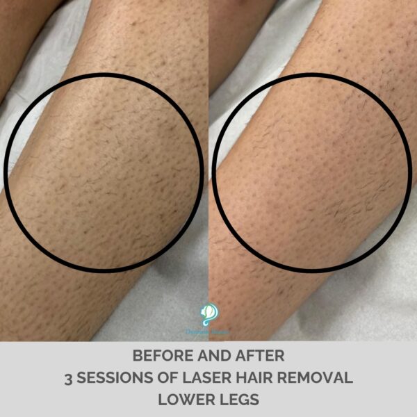 3 Sessions of Laser Hair Removal Lower Legs (1)