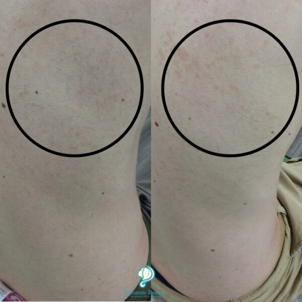6 Sessions of IPL Hair Removal Back (1) (1)