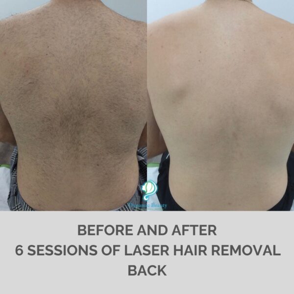 6 session of IPL hair removal Back (1)