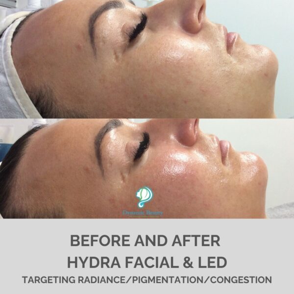 Hydra Facial & LED (1)