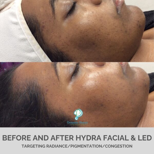 Hydra Facial & LED (2)