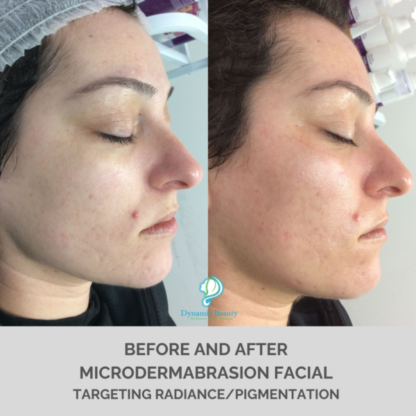 _Microdermabrasion facial (1)