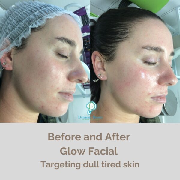 Radiance Facial before and after (2)