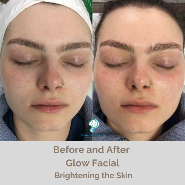 Radiance Facial before and after (3)