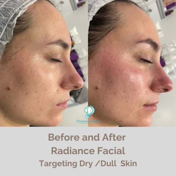 Radiance Facial before and after (4)