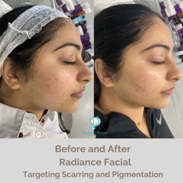 Radiance facial before and after (1)