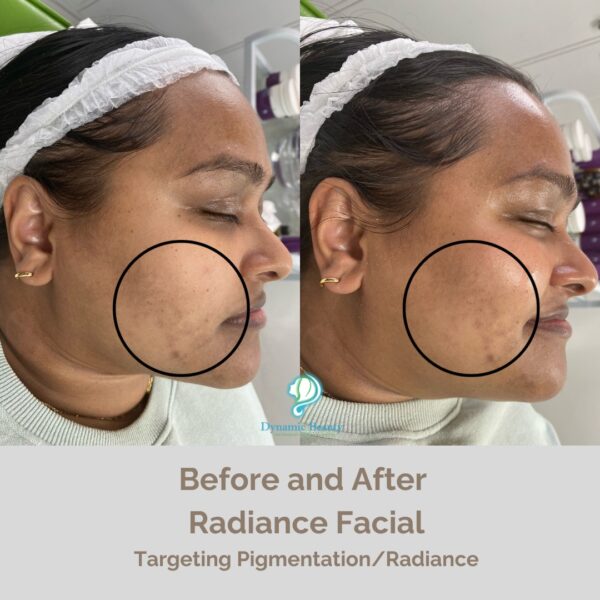Radiance facial before and after