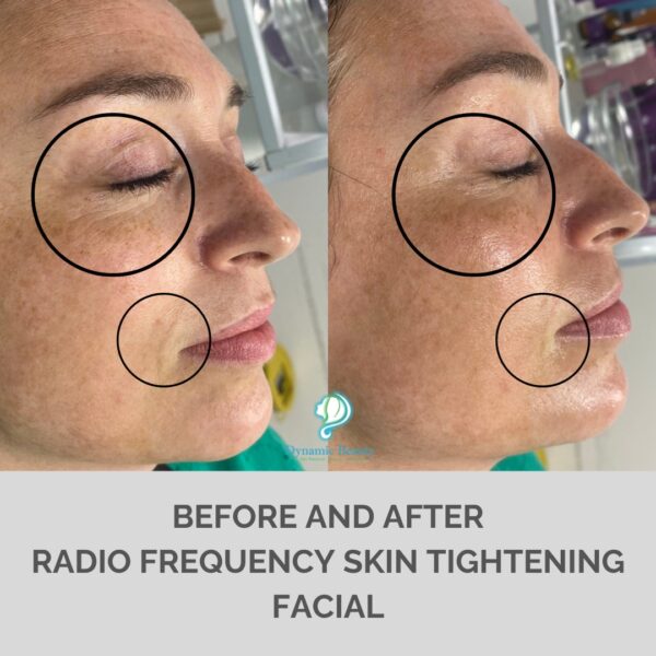 Radio Frequency Skin Tightening Facial (1)