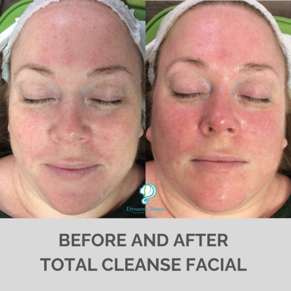 Total Cleanse facial 3