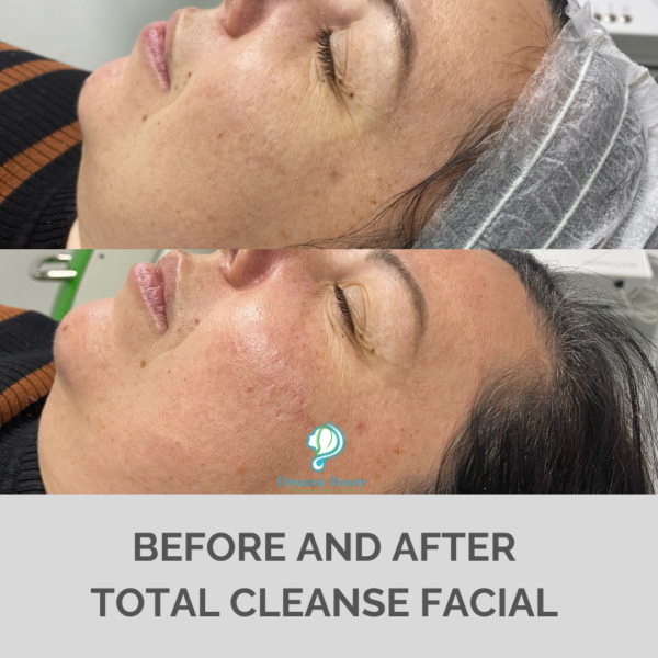 Total Cleanse facial 6