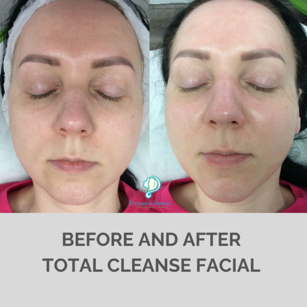 Total Cleanse facial 9